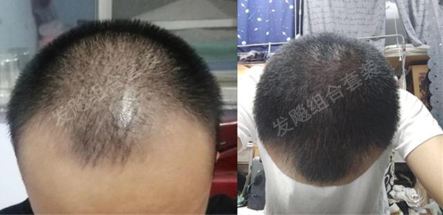 治愈脫發(fā)最新重大突破，重塑自信，希望之光再現(xiàn)