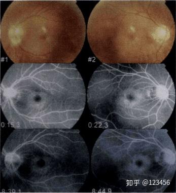 最新藥肺炎詳解，你需要知道的一切——健康小紅書